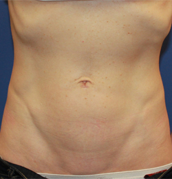Arlington Mini Tummy Tuck Before and After Photos - Texas Plastic Surgery  Photo Gallery - Dr. Anthony Tran