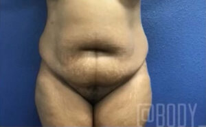 Tummy Tuck