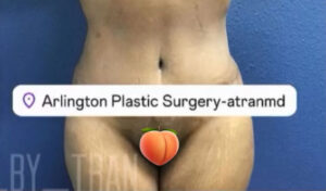 Tummy Tuck