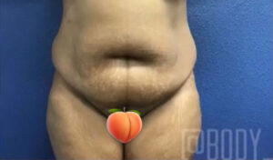 Tummy Tuck